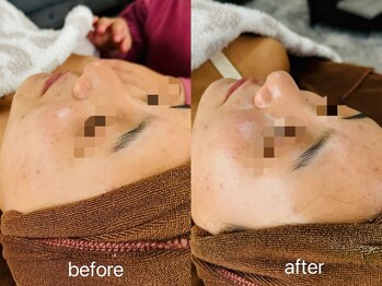 ルーク(Luke)/ハーブピーリング（シルク追加）