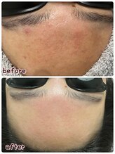 ケースタイル(k.style)/ニキビケア