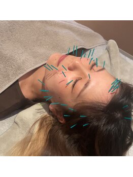 ハルノハナ鍼灸治療院 丸の内院/フェイスライン&体質の改善