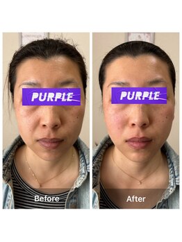 サロン ド アヤ(salon de Aya)/一回施術で小顔/たるみ血行改善