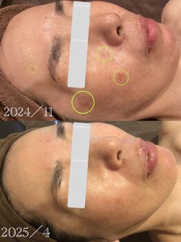 マロー(Mallow)/しみフェイシャルのビフォアフ