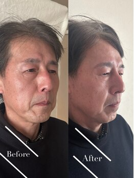 Winsome新宿店【メンズアイブロウ/眉毛/脱毛/毛穴洗浄/ホワイトニング/ヘッドスパ】の写真/見た目も頭もスッキリ整う★【眉毛wax+ドライヘッドスパ】疲れ顔や重たい印象を解消!仕事帰りも通える◎