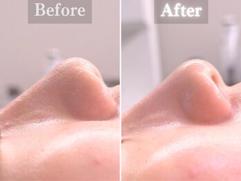 ボーンオム(Born Homme)/毛穴洗浄+美容液導入:30代女性