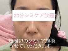 サクラ(SAKURA)/20分の施術範囲（個人差あり）