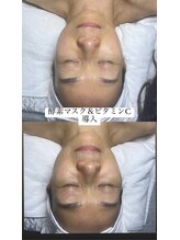 ハイビューティー 渋谷(Hi Beauty)/酵素マスク