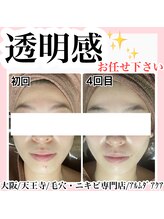 アルムダアクア 天王寺店(Aleumda AQUA)/ハーブピーリング/大阪/天王寺