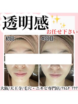 アルムダアクア 天王寺店(Aleumda AQUA)/ハーブピーリング/大阪/天王寺