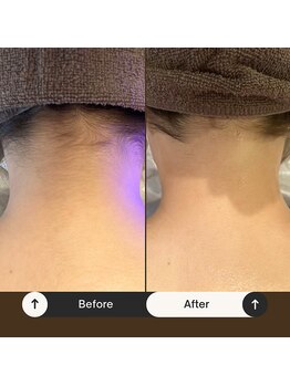 チャンティック(Cantik)/ブライダルケアのお客様♪