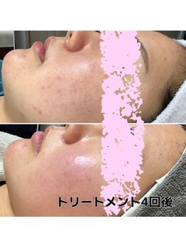 エステティックサロン S/跡ケア、ニキビケア