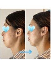 クリスタルミー 横須賀(Crystal me)/エラ、アゴ、フェイスライン矯正