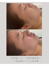 マホロバ(mahoroba)/ダーマ鍼/美容鍼/表参道