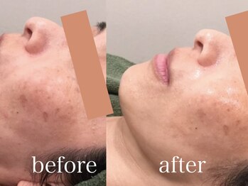 エピラックス(epilax)/プラズマパールリフト