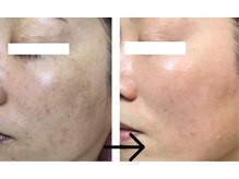 コトハ(cottha)/シャルムボー肌改善