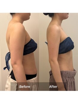 リバース(Rebirth)/脂肪燃焼剤10ml導入