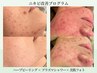 【赤み炎症ニキビ】根本改善プログラム◇プラズマ×ハーブ×美肌フォト