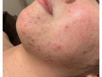 ビューティーサロン アンド ユー シブヤ(Beauty Salon&U Shibuya)/クリスティーナ施術前