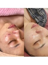 レイネイル レイエステティック 岐阜茜部店(RAY NAIL & RAY ESTHETIC)/本気の改善！
