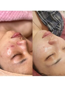 レイネイル レイエステティック 岐阜茜部店(RAY NAIL & RAY ESTHETIC)/本気の改善！