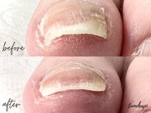 ツメハピ(tumehapi)/巻爪ケア1回目