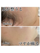 ビューティースタジオ ティー(Tiy)/フェイシャルwax脱毛