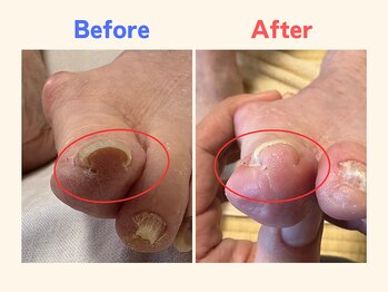 ピース/巻き爪で歩くのが辛い70代女性