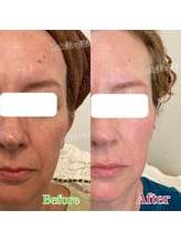 ラブ美長寿 沖縄本店(Lab)/ビフォーアフターエンダモリフト