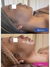 ユフラ(Juhla)/【切らない小顔リフト】サーマル