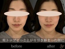 チョコバリ 恵比寿店(chocobari)/小顔リフトアップ（美容鍼）20代