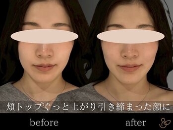 チョコバリ 恵比寿店(chocobari)/小顔リフトアップ（美容鍼）20代