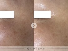 スパレーカ(Spa laka)/シミ・目尻のシワ