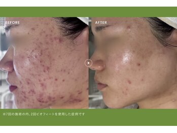 ミレラ(Mirela)の写真/温冷新感覚ハーブで毛穴とお顔をキュッと引き締め、頑固なニキビにアプローチ！圧倒的小顔・スッキリ感◎