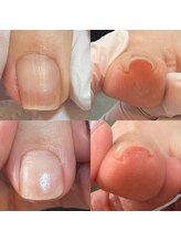 ウェルズユキ(well's yuki)/巻き爪／陥入爪