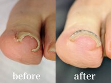 ドクターネイル爪革命 札幌本店/症例紹介１０　巻き爪