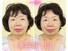アイワ鍼灸整骨院の雰囲気（目もパッチリ開いて、顔の大きさもひとまわり小さくなりました。）