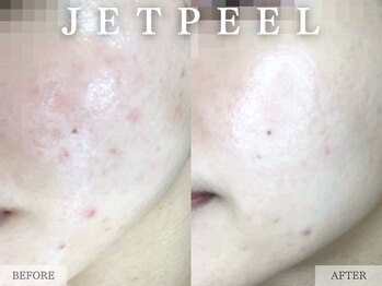 レヴェリー 心斎橋店(REVERIE)/‐ マイルドピーリング ‐