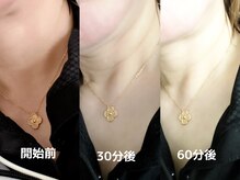 ヨサパーク ボヌール 門司駅店(YOSA PARK bonheur)/首からフェイスラインの変化！