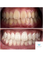 ホワイトニングショップ 奈良生駒店/20代のBefore、After☆