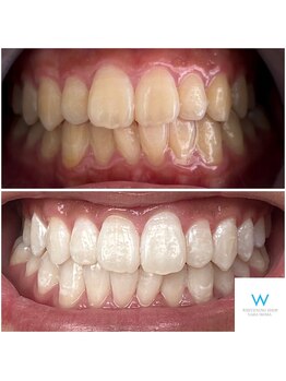 ホワイトニングショップ 奈良生駒店/20代のBefore、After☆