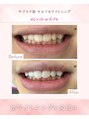 エクシアホワイトニング 天王寺店 通い放題プランで理想の白さをキープ♪男性にも人気セルフケア!