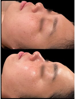 シェノン(Chainon)/【セラピール3回】疲れ顔、卒業