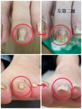 名古屋駅前巻き爪センター/巻き爪