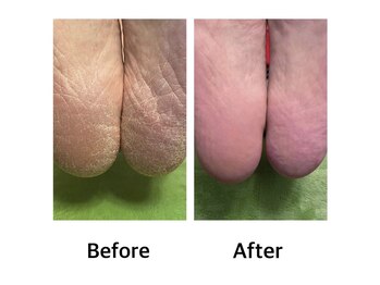 ノンティエール(Non-Tyell)の写真/保湿成分配合ローション使用の足裏角質ケアと甘皮処理で、足元からツルツル長持ちを実現◎