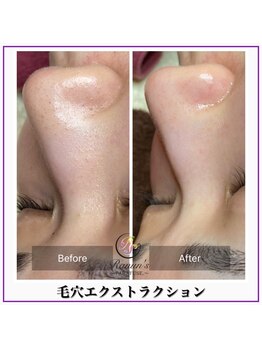 ラナン パラフューズ(Ranun's PARAFUSE.)/毛穴ビフォーアフター(5)