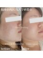 リニューサロン 本院(renew salon)&nbsp;肌質を根本から改善したい方におすすめ♪ハーブピーリング！