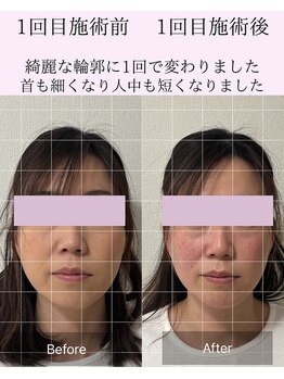 マハロ 海老名店(Mahalo)/小顔矯正　40代女性　
