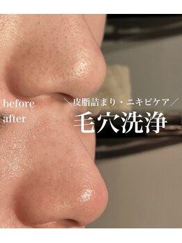 トータルエステサロン ポイント(POINT)の写真/毛穴の黒ずみや開きを徹底的に改善！お肌の汚れを取り除いてニキビケア◎透明感のある毛穴レスなツヤ肌に♪
