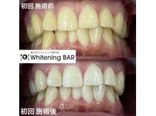ホワイトニングバー 町田店/初回ビフォーアフターをご紹介