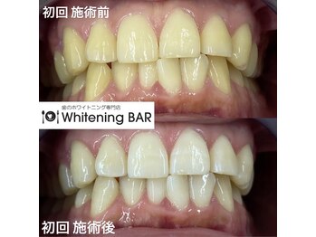 ホワイトニングバー 町田店/初回ビフォーアフターをご紹介