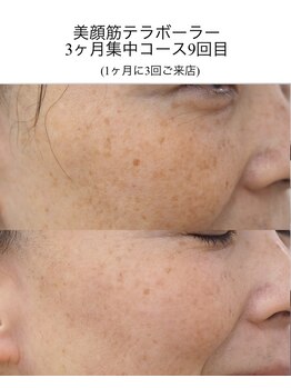 キューティ(Cutie)/テラボーラー　ビフォーアフター