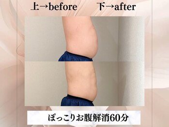 イヨヨ(iyoyo)/【痩身】Before After